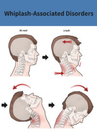 whiplash car accidents