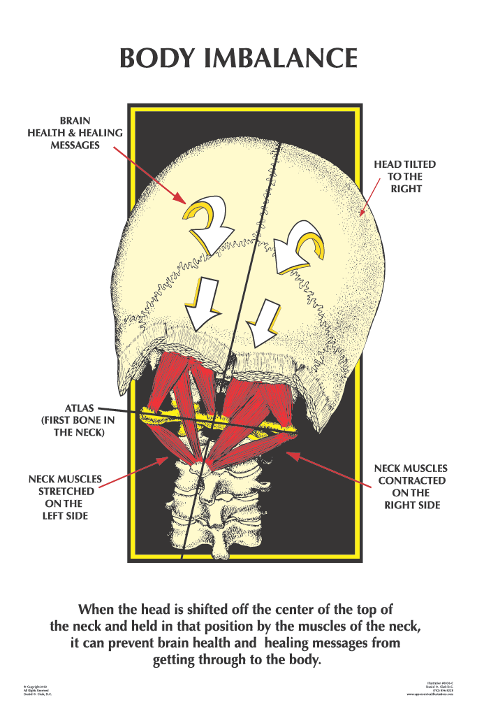 how upper cervical misalignment causes pain