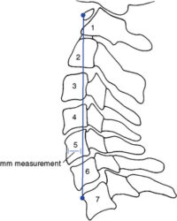 Figure 5-42 Jochumsen’s measuring procedure for determining the adequacy of the cervical curve.