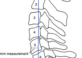 Figure 5-42 Jochumsen’s measuring procedure for determining the adequacy of the cervical curve.