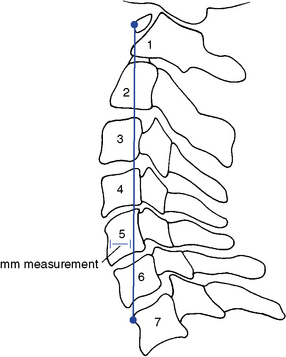 Figure 5-42 Jochumsen’s measuring procedure for determining the adequacy of the cervical curve.