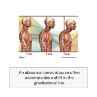 abnormal cervical curve