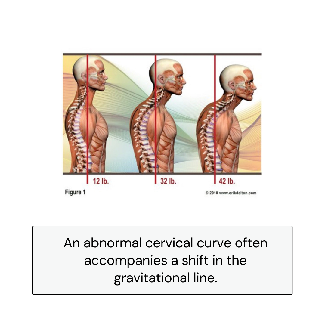 abnormal cervical curve
