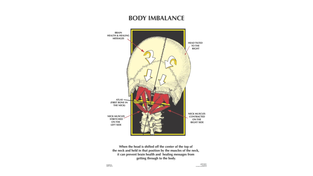 atlas_subluxation_complex_upper_cervical_care